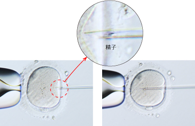 In vitro fertilization, microinsemination