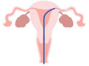1、FTを挿入、卵管の入口確認しているイラスト