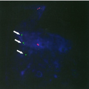 Trisomy detection image by FISH method