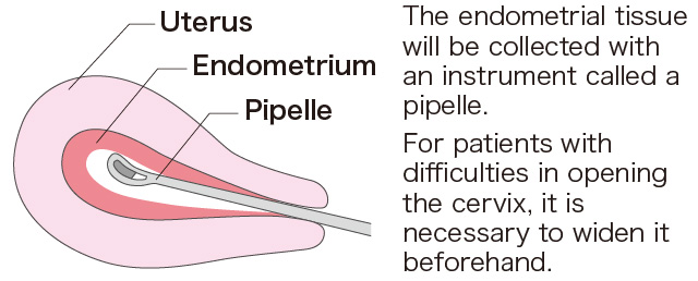 Regarding Endometrial Tissue Retrieval