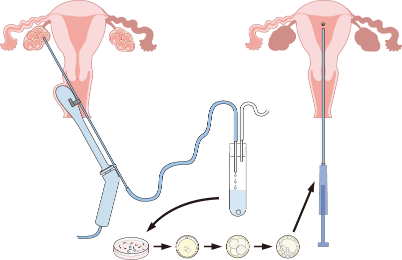 Flow of IVF-ET