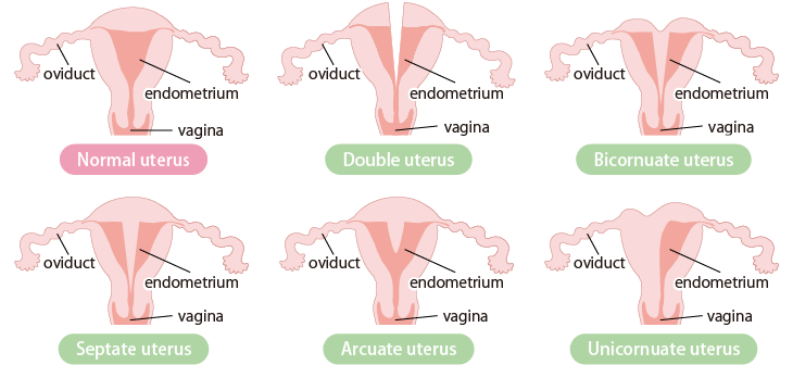 Main examples of uterine malformation