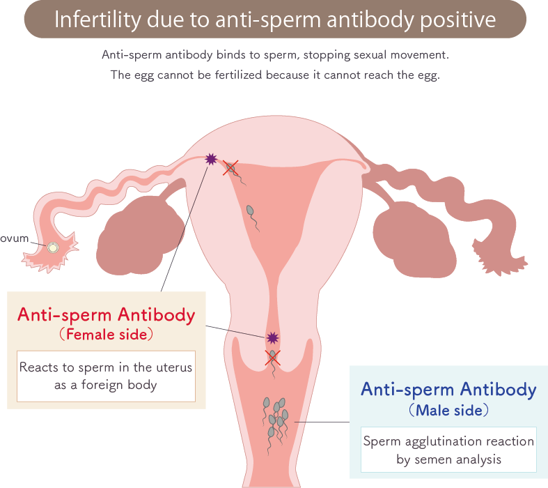 Infertility due to positive antisperm antibodies
