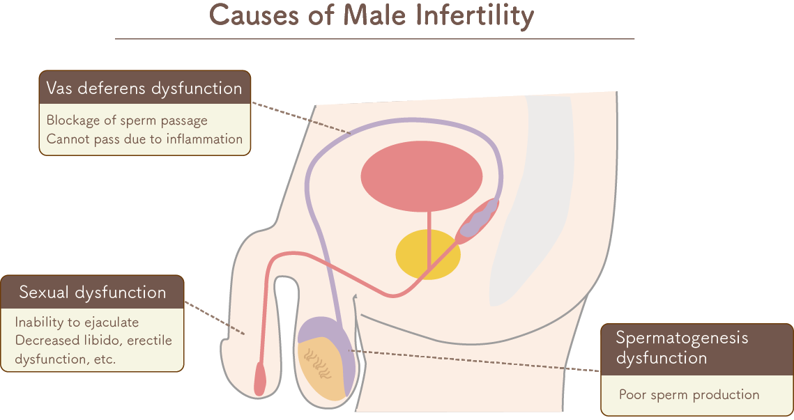 Male Infertility Causes