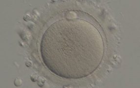 卵胞発育不良