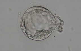 低グレード胚盤胞の妊娠・出産例
