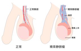 精子の状態と精索静脈瘤