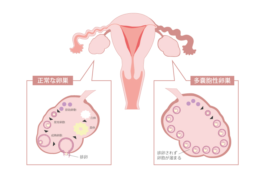 多嚢胞性卵巣での排卵誘発法 | 医療法人オーク会 不妊ブログ