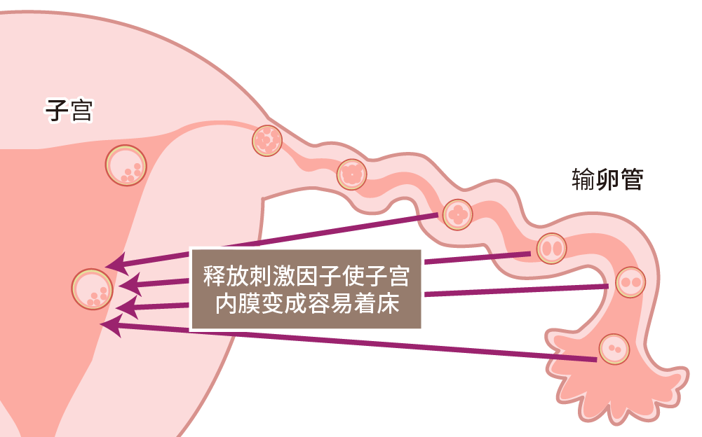 Oak式子宫内膜刺激胚胎移植法