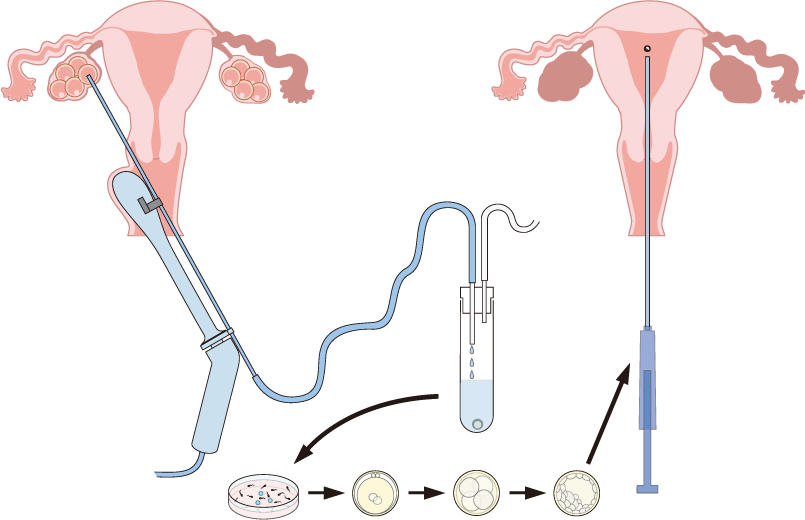 IVF-ET流程