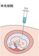 羊水穿刺