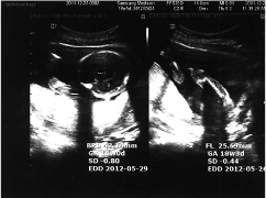 胎児超音波検査