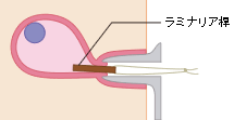 ラミナリア桿