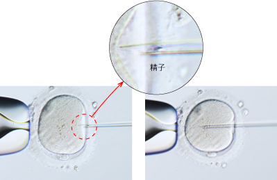 体外受精、顕微授精