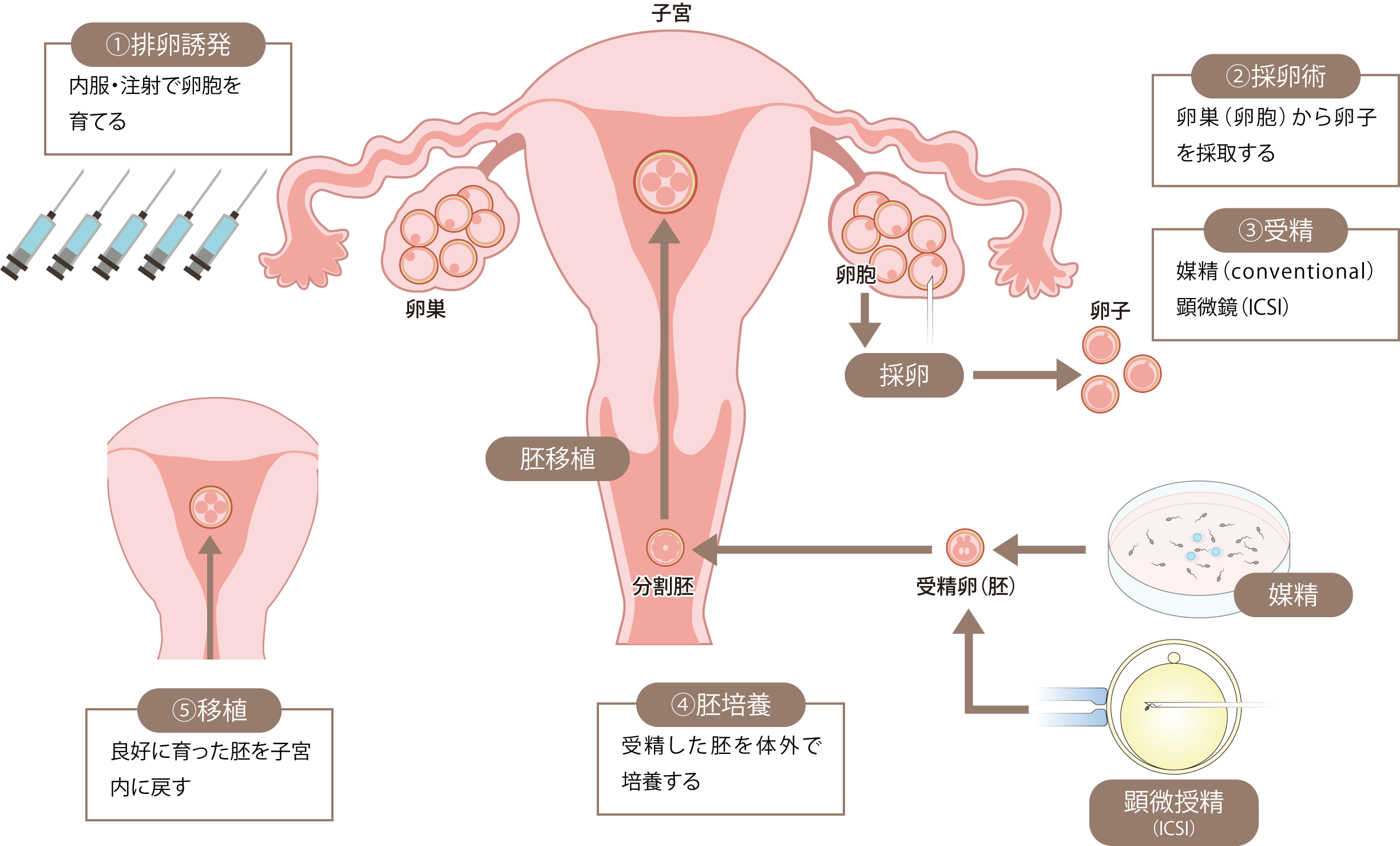 体外受精の流れ