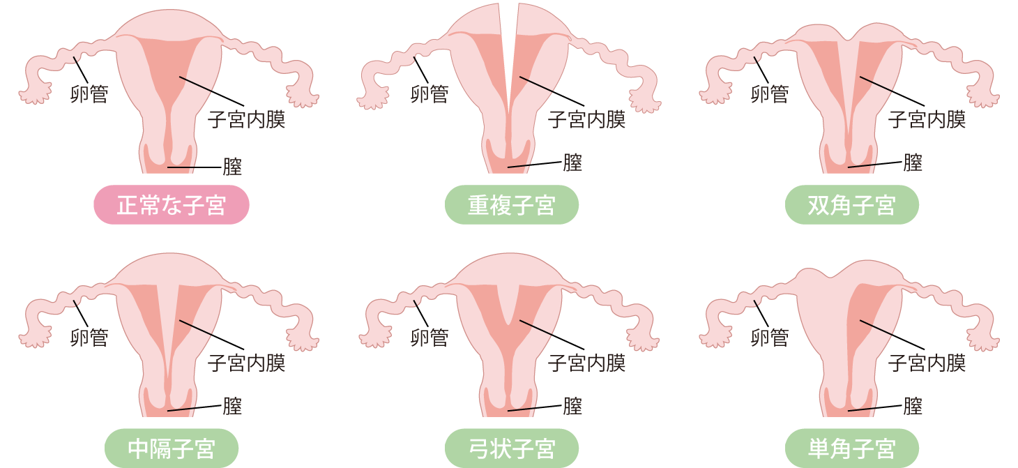 子宮形態異常の主な例