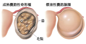 卵巣嚢腫イラスト