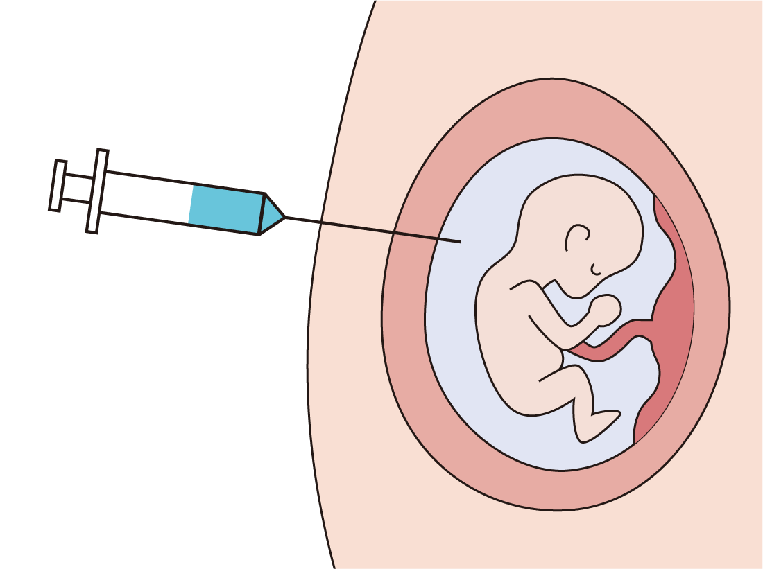 羊水検査イメージ