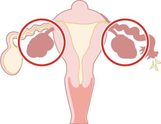 子宮・卵巣の病気