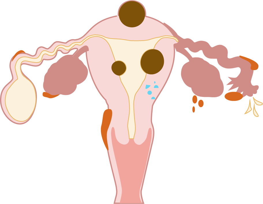 Uterine and Ovarian Illnesses