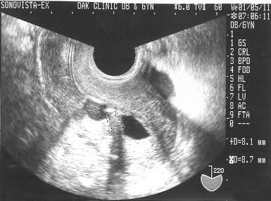 子宮内膜ポリープ【ソノヒステログラム画像】