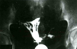 子宮内腔癒着 アッシャーマン症候群 の原因 検査 治療 医療法人オーク会