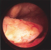 Endometrial Hyperplasia