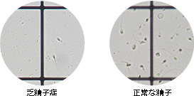 稀精子症