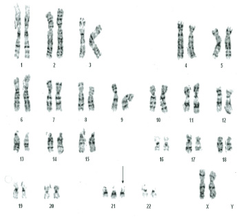 Trisomies