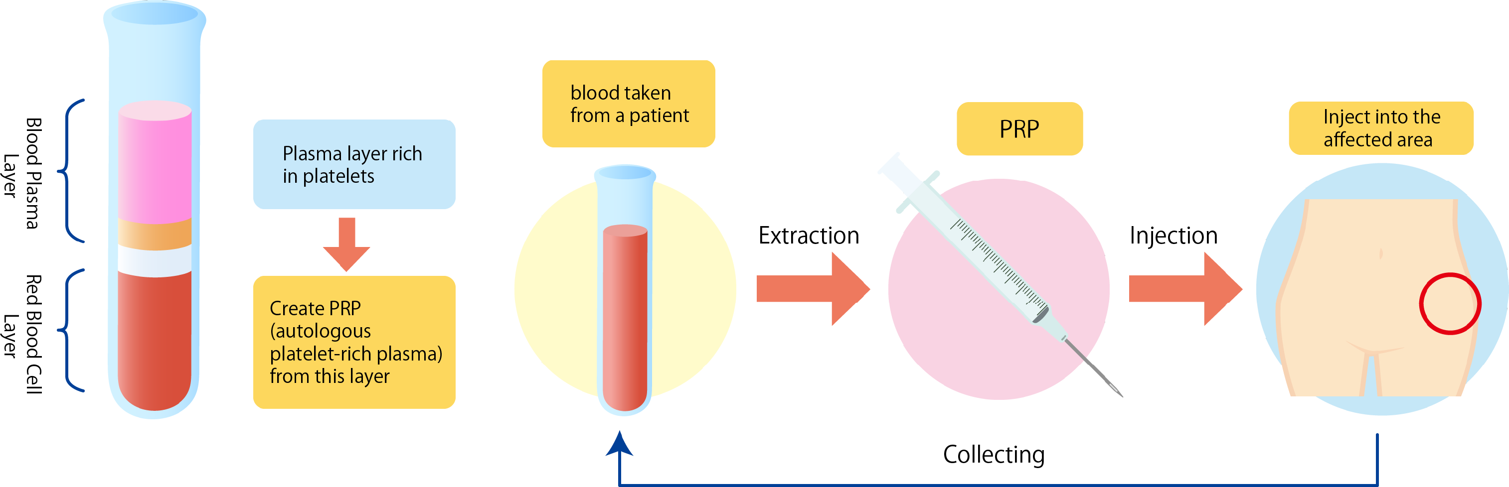 Principle of PRP Therapy