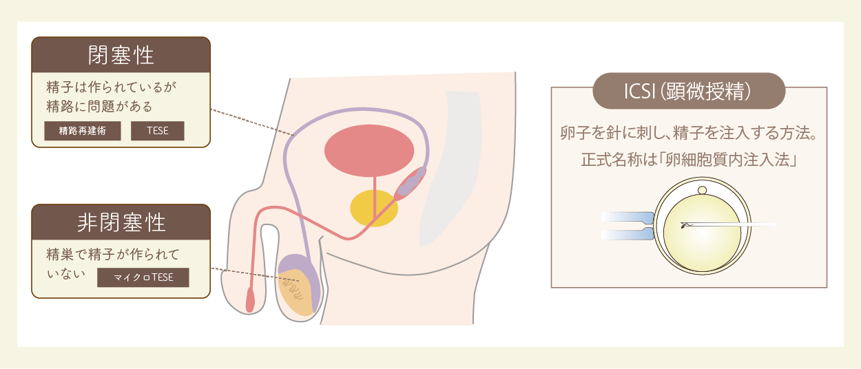 無精子症