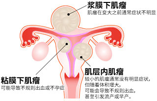 子宮筋腫