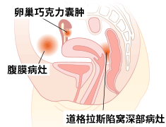 关于子宫内膜异位症
